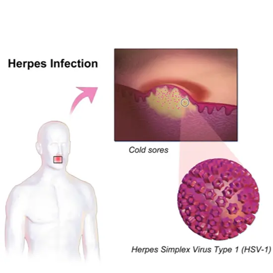 Herpes Simplex Virus 1+2 Antibodies Test